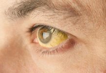 Zlatenica – Jetrna bolezen, ki jo lahko blažimo s prehrano