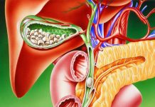 Žolčni kamni – ter ostale bolezni žolčnika in žolčevodov – žolčna dieta