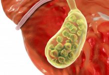 ŽOLČNI KAMNI – Prehranski dodatki, ki odpravljajo težave žolčnih kamnov
