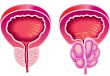 Povečana prostata / Prostatistis – Akupresurna terapija, ki zmanjšujejo povečano prostato