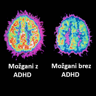 ADHD-možgani