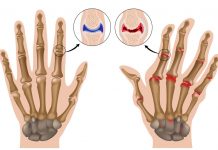 Artritis in revma – akupresurne točke za lajšanje artritisa in revme